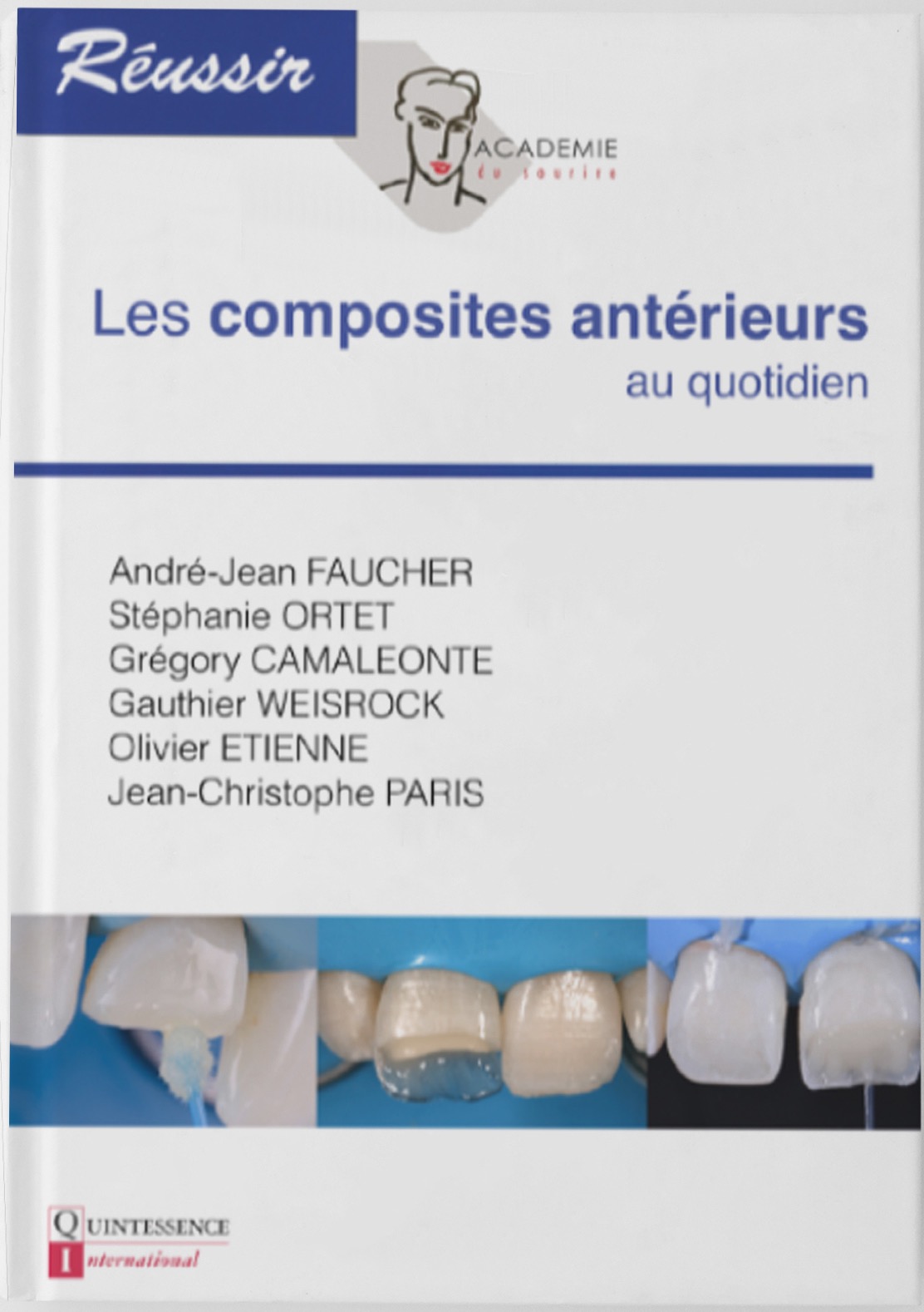 Les composites antérieurs